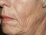 Sculptra