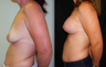 Breast Lift with Implants, Mastopexy