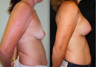 Breast Lift with Implants, Mastopexy