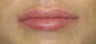 27 year old undergoing lip augmentation