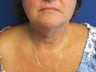 56 Year Female With Excess Neck Fat
