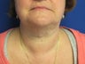 56 Year Female With Excess Neck Fat