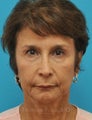 Female with brow and eyelid hooding treated with browlift and upper blepharoplasty