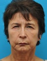 Female with brow and eyelid hooding treated with browlift and upper blepharoplasty