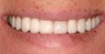 Porcelain Veneers