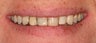 Porcelain Veneers