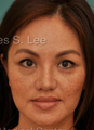 Asian Nose Surgery