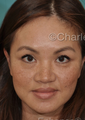 Asian Nose Surgery