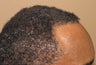 Neograft Fue hair transplant in African American Male