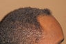 Neograft Fue hair transplant in African American Male