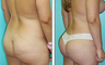 Brazilian Butt Lift Before & After