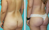 Brazilian Butt Lift Before & After