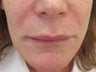 46 year-old female treated for laugh lines with Juvederm
