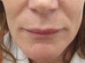 46 year-old female treated for laugh lines with Juvederm