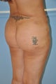 brazilian butt lift