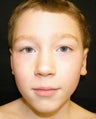 Otoplasty