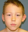 Otoplasty