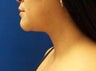 Neck Liposuction