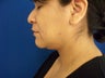 Neck Liposuction