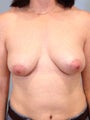 41 year-old woman undergoes bilateral implant removal, left breast lift, and right breast fat grating for old implants