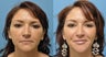 Los Angeles Microcannula Lip Augmentation Juvederm