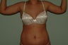 Brachioplasty