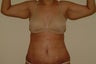 Brachioplasty