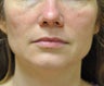 43 Year Old Woman treated with Ultherapy and Sculptra
