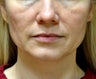 43 Year Old Woman treated with Ultherapy and Sculptra