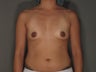 28 year old woman treated for assistance with breast volume.