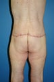 male body lift