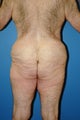 male body lift