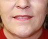 Corner of Lip Lift