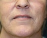 Corner of Lip Lift