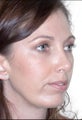 Rhinoplasty and Chin Augmentation