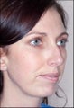 Rhinoplasty and Chin Augmentation