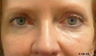 Belotero