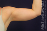 Liposuction of the Upper Arms
