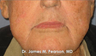 Lip Reconstruction