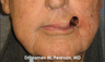Lip Reconstruction