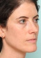 Sciton BBL and Microlaser peel - One Treatment, 2 weeks post op