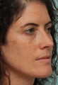 Sciton BBL and Microlaser peel - One Treatment, 2 weeks post op