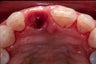 Gum Graft Around Implant