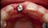 Gum Graft Around Implant