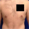 Laser Liposuction
