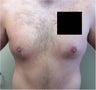 Laser Liposuction