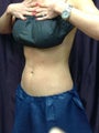 Coolsculpting