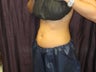 Coolsculpting