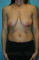 Breast Lift