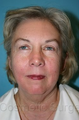 Facelift